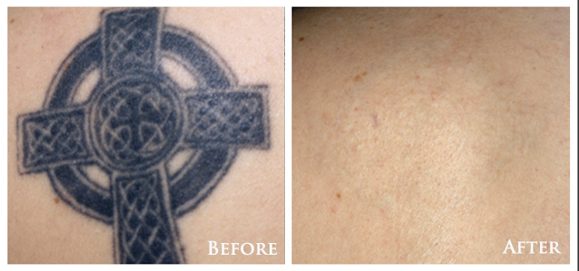 Laser Tattoo Removal, Q Switched Yag Laser Eyebrow Tattoo Removal, Cosmetic  tattoo treatment